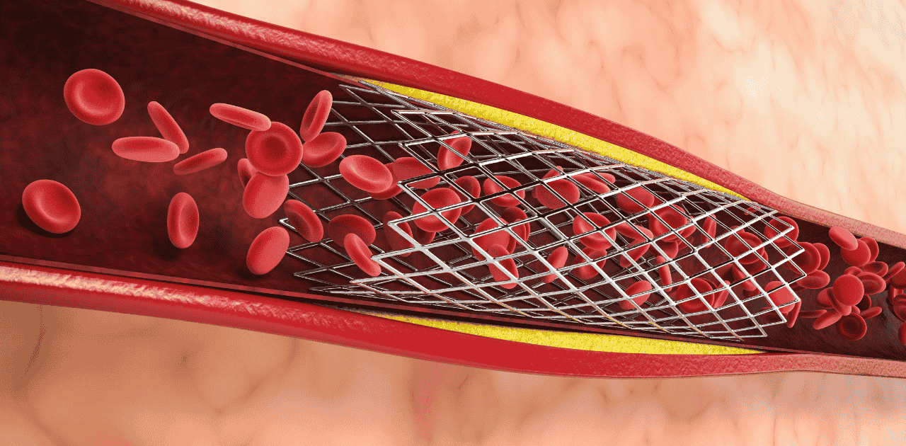 Stenting: How It Helps Prevent Heart Attacks
