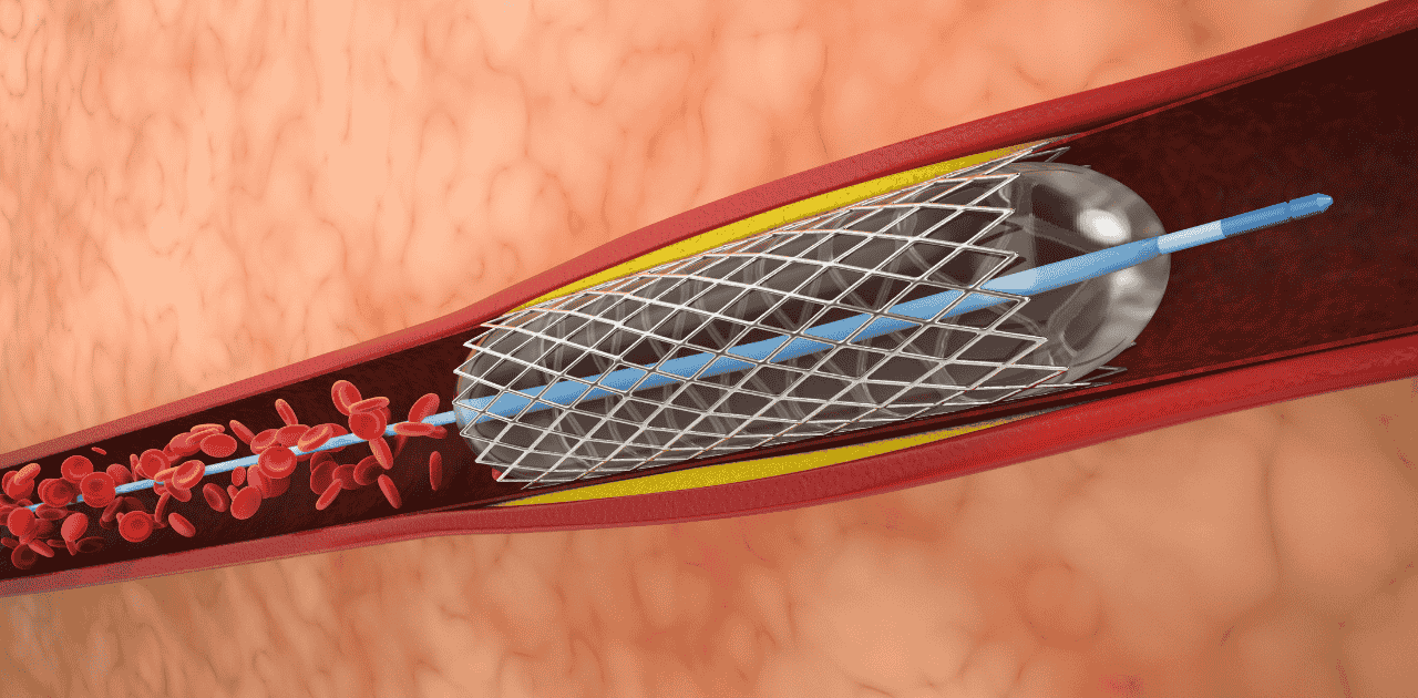 What Is Angioplasty? A Minimally Invasive Solution for Blocked Arteries