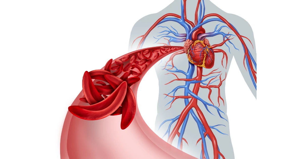 Microvascular Angina: The ‘Hidden Heart Blockage’ Doctors Often Miss
