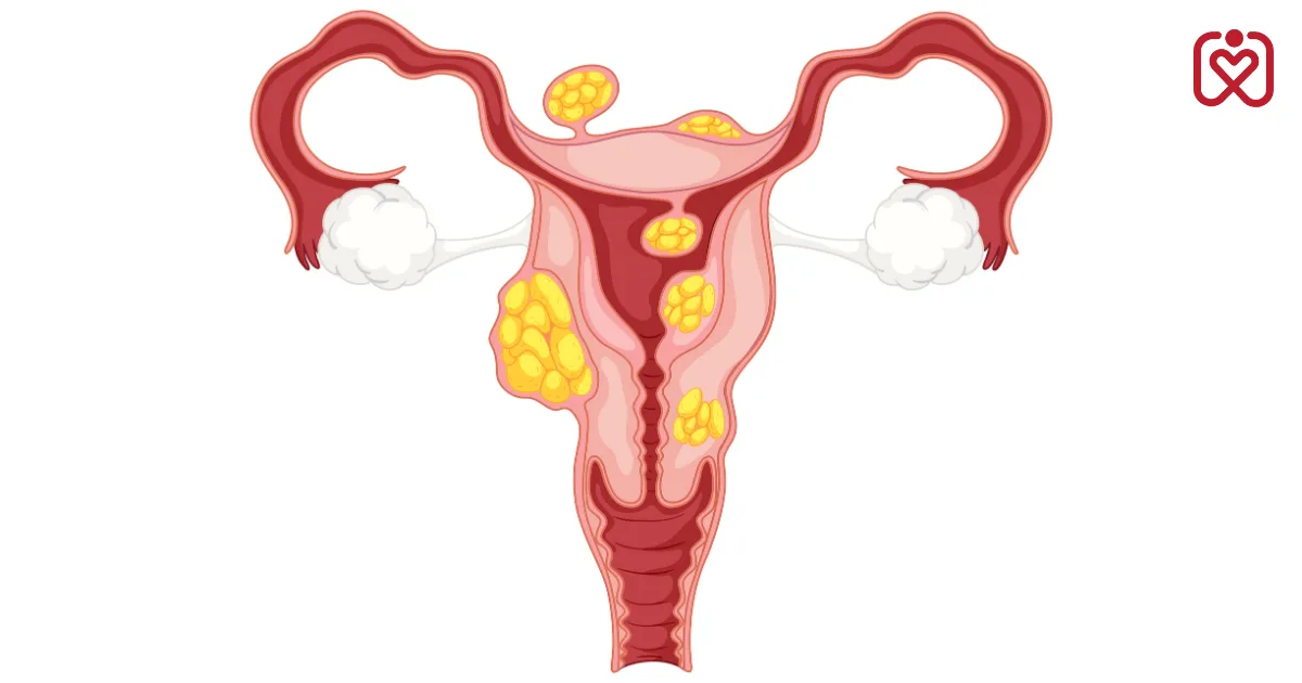 Endometriosis & Heart Disease: The Surprising Link