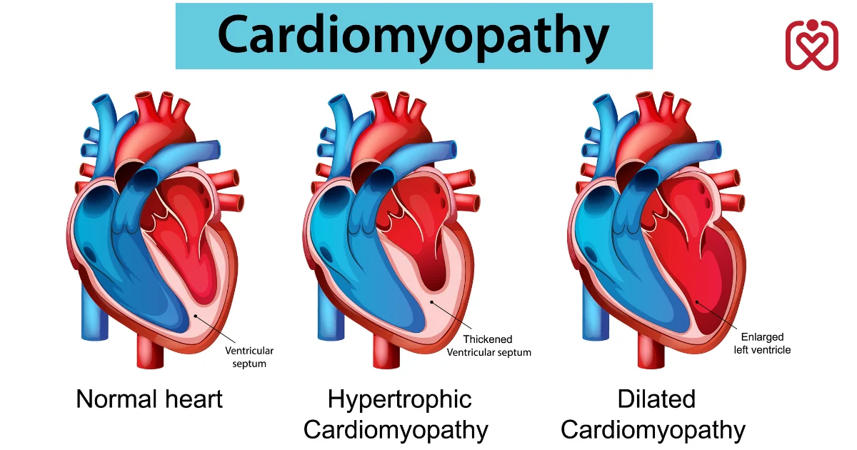 Hypertrophic Cardiomyopathy: Why It Often Goes Undiagnosed