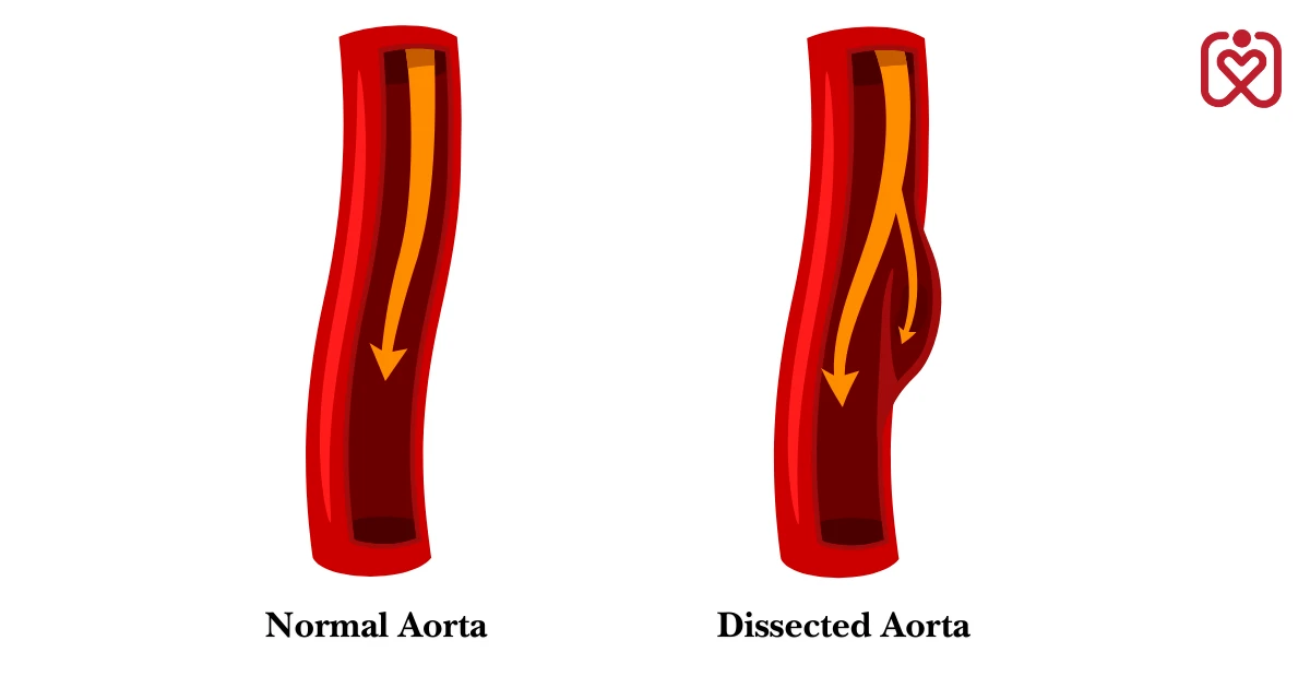 Aortic Dissection: The Rapid, Silent Emergency Everyone Should Know